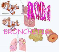 Bronchitis : Bronchitis