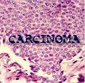 Carcinoma (CHL) : Carcinoma