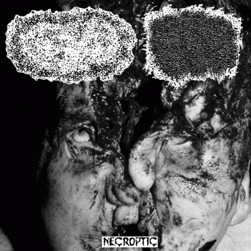 Lymphangiomas : Necroptic Lymphangiomas : Necroptic