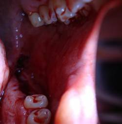 Yzordderrex : Extraction